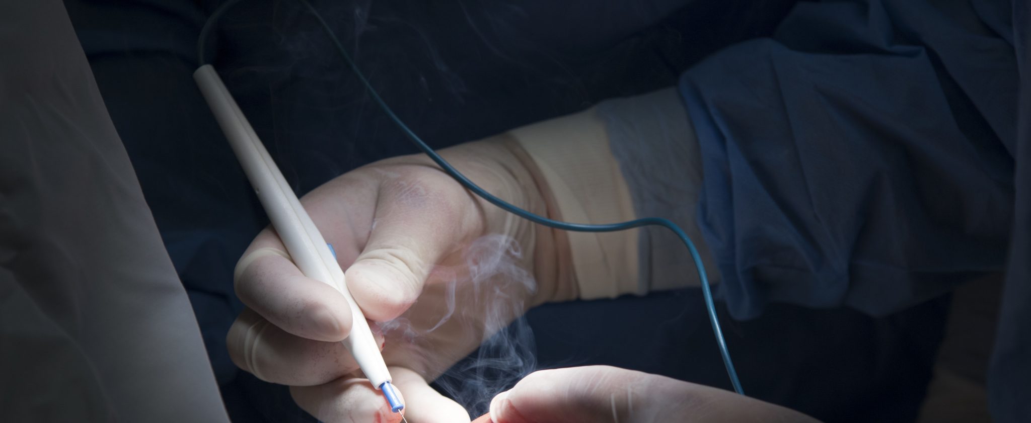 Team at UHWI Finds Affordable Solution for Surgical Smoke