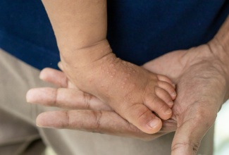 Signs of Hand, Foot and Mouth Disease (HFMD) in children.
